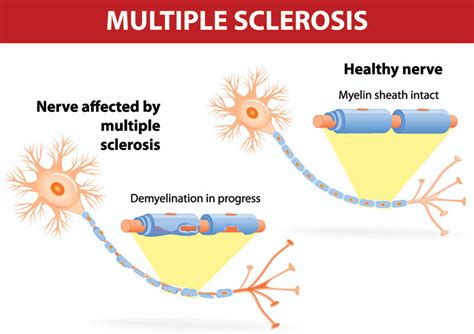 Get To Know Multiple Sclerosis A Neurological Disease Affecting The