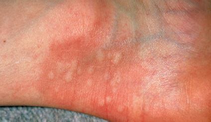 Most viral infection that causes upper respiratory tract and gastrointestinal inflectional red bumps on legs that are caused due to bug bites also tend to run through their course. White Bumps on Legs: Small, Itchy, Hard Raised Spots on ...