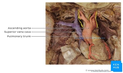 Pulmonary embolism: Clinical anatomy | Kenhub