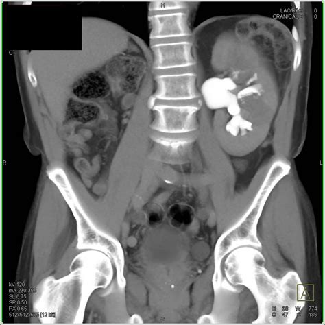 Tcc Left Kidney And Right Side Of Bladder Kidney Case Studies