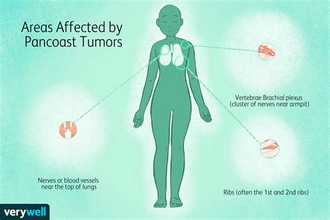 Was Ist Ein Pancoast Tumor Medde