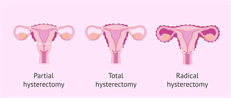Hysterectomy Selma Cornell
