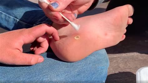 How To Freeze A Wart With Liquid Nitrogen Youtube