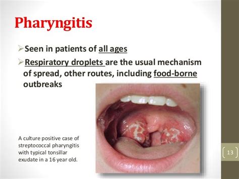 Streptococcal Infections