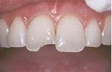 Photos of Tooth Filling Material Side Effects