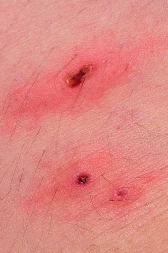 Tick Bites On Hairy Human Skin With Scabs Forming Stock Photo