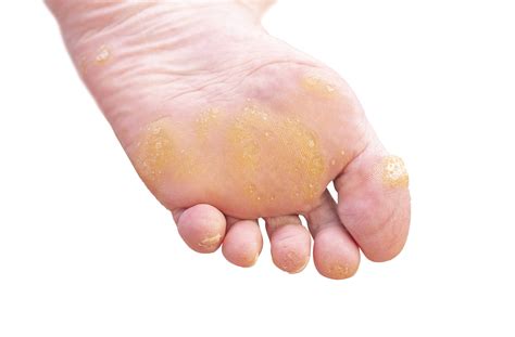Corns And Callus What Are They And How Do We Treat The Healthcare Hub