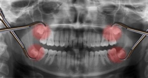 does everyone have to get their wisdom teeth out boston dentist congress dental group 160