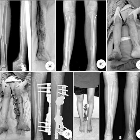 A A 15 Year Old Female Sustained Open Fracture Of The Tibia And