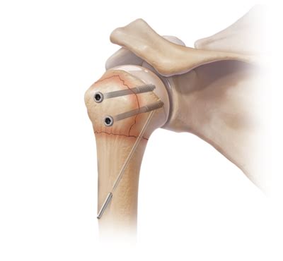 Arthrex - Humeral Fracture Implants