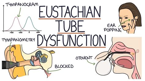 Eustachian Tube Dysfunction How To Pop Ears Medicine Student Body Is
