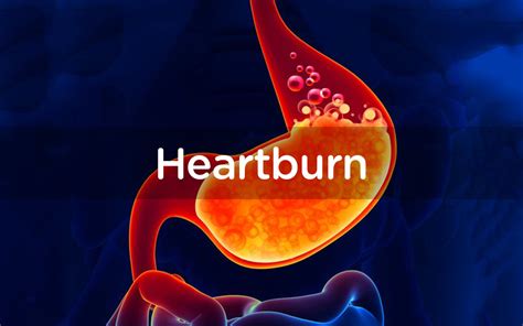 Heartburn Choice Pharmacy