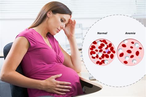 Anemia In Pregnancy Symptoms And Types Of Anemia During Pregnancy