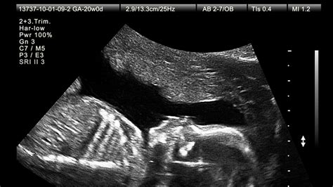 What To Expect At Your 20 Week Ultrasound Appointment