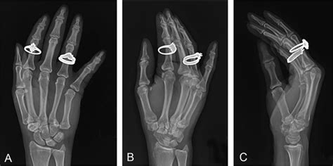 Isolated Volar Dislocation Of The Fifth Carpometacarpal Joint Ochsner