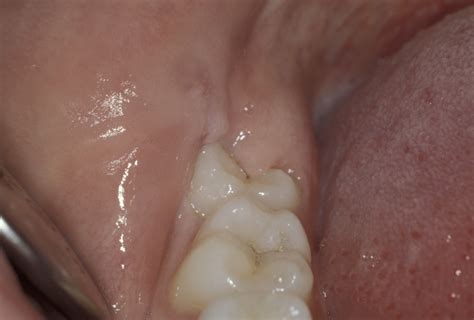 Ectopic Displaced Teeth