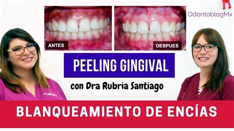 Peeling Gingival ó Blanqueamiento De Encía Youtube