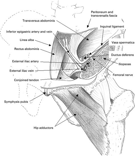 Sports Hernias A Systematic Literature Review British Journal Of
