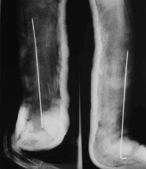 Radiograph Showing A Fibular Graft Stabilised By An Intramedullary