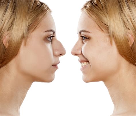 Rhinoplasty Before And After Plastic Surgery Of The Nose Carolina
