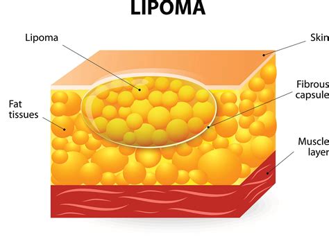 Lipoma Diagram