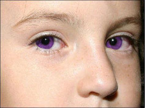 Purple Eyes Causes Purple Eye Color Disease Makeup Tips Were