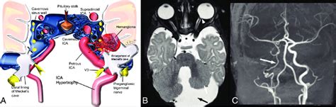 A Asymmetrical Enlargement Of Meckels Cave In Patients With Phace