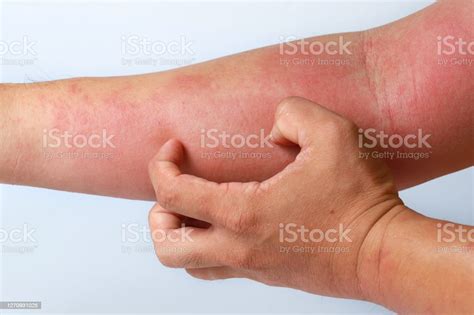 Eczema Allergy Skin Atopic Dermatitis Stock Photo Download Image Now