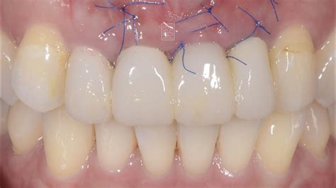 牙齦邊緣萎縮，瓷牙冠邊緣變黑，橋體下牙齦萎縮————全瓷牙橋併牙齦移植手術 案例介紹 美容牙科張凱榮醫師