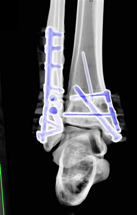 Open Reduction Internal Fixation Orif Of Tibia And Fibular Fractures