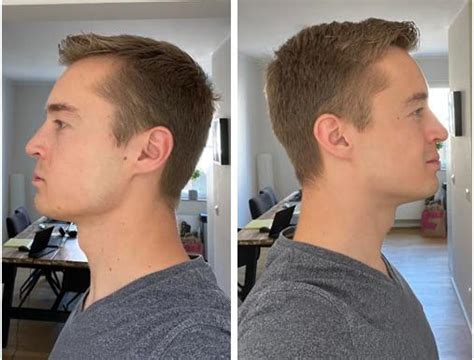 M25 Do I Have A Recessed Jaw Or Enough Forward Growth Also Do I Have