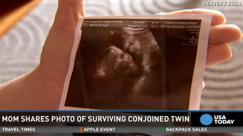 minn mom shares photo of surviving conjoined twin