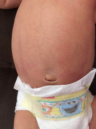 Worried About Baby Bruising Not Going Away Babycenter