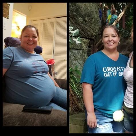 Gastric Bypass Surgery Before And After Pictures Past Patient Photos