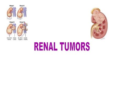 Renal Tumors
