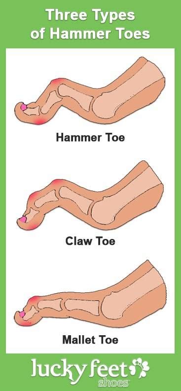 To stop shoes rubbing your toes and hurting your pinky toe, you need to follow few simple precautions. Hammer Toes Info, Shoes & Arch Supports | Common Foot Problems