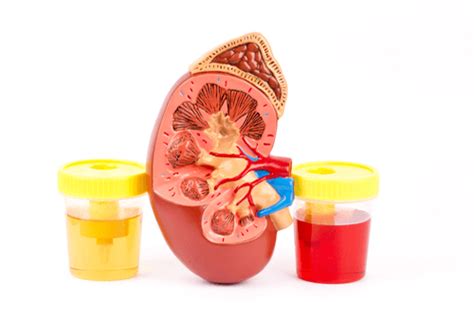 Kidney Cysts Risk Factors Symptoms Complications And Treatment Factdr