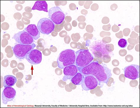 Acute Myeloid Leukaemia Without Maturation Cell Atlas Of