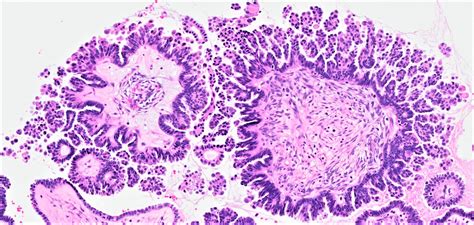 Pathology Outlines Serous Borderline Tumor