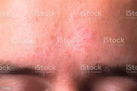 Weeping Eczema In The Stage Of Exudation Closeup Of Forehead Area With