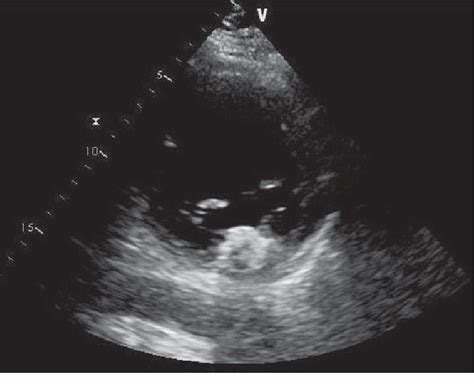 A Case Of Caseous Calcification Of A Mitral Annulus With Mitral