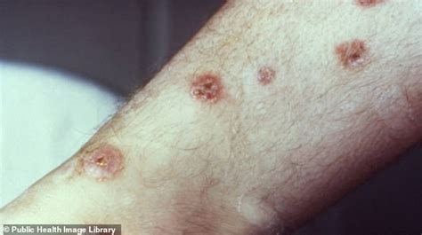 Syphilis Explosion Urgent Warning As Cases Soar In New Zealand Daily