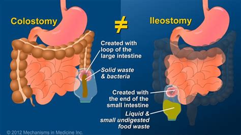 It Is Important To Know That An Ileostomy Is Not A Colostomy An Ileostomy Is Created With The