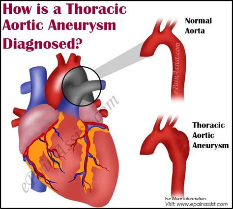 Thoracic Aortic Aneurysm Diagnosis