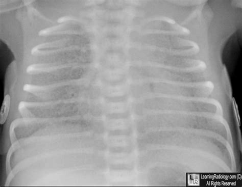 LearningRadiology Respiratory Distress Syndrome Of The Newborn