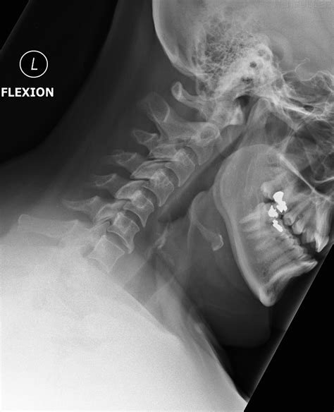 Flexion And Extension Cervical Spine Radiography Wikiradiography