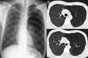Unilateral Hyperlucent Lung Associated With Bronchial Atresia Mimicking