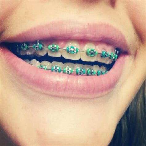 The Best Braces Color Ideas For Spring 2022