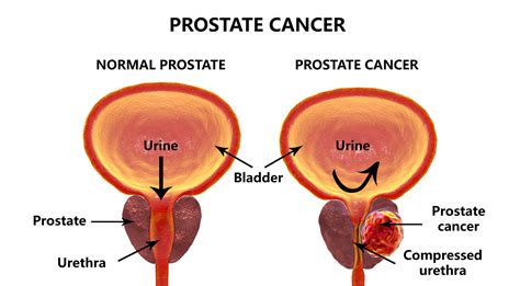 The Expect Examining Exercise Prostate Cancer And Circulating Tumour