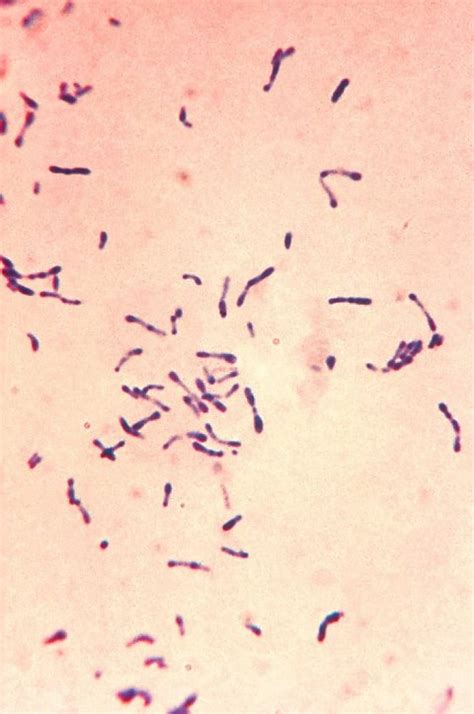 Antibiotic Resistance Could Make Diphtheria ‘major Global Threat Again